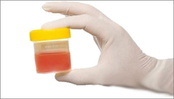 blood clots in urine